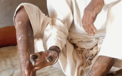 RAKHA’S STORY | GANGRENE FROM UNTREATED DIABETES