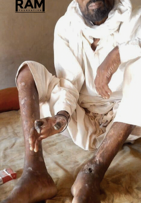 RAKHA’S STORY | GANGRENE FROM UNTREATED DIABETES
